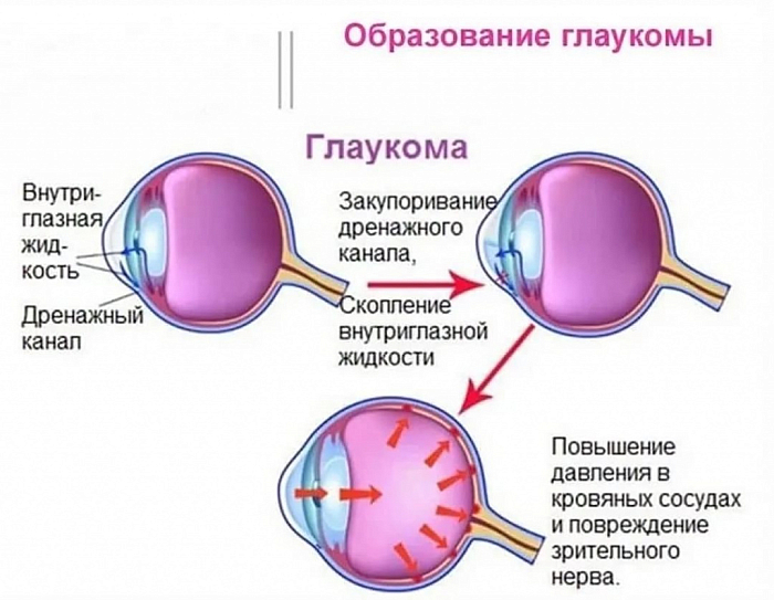 Глаукома глаза